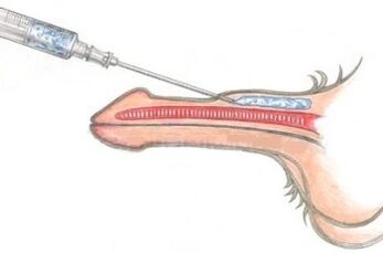 Un método perigoso para aumentar o pene usando inxeccións de vaselina